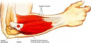 Lateral Epicondylitis | Musculoskeletal Treatment